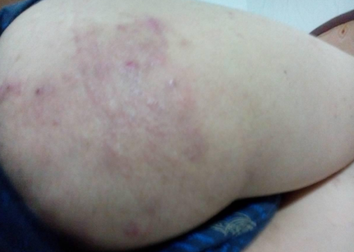 如何准确区分阴囊湿疹与股癣，症状、诊断与治疗全解析怎么判断阴囊湿疹和股癣